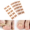 Zelfklevende patch met een plaat voor het corrigeren van ingegroeide nagels, sticker, 10 stuks, nagelhouder-952732950-Foot care-Podologie