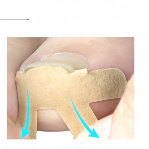  Ensemble de patchs de correction d'ongle incarné, 4 pièces, élastique, respirant, récupération, correction, fixateur, os
