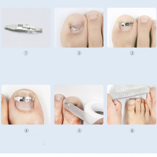Reusable No. 42 stainless buckle for correcting, correcting, fixing ingrown, crooked nails, 3744, Orthonyxia. Everything for correcting ingrown toenails,  Health and beauty. All for beauty salons,All for a manicure ,Subology, buy with worldwide shipping