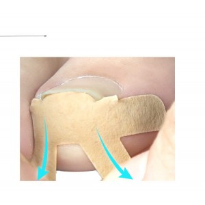 Set of patches for the correction of ingrown nails, 4 PCs, Elastic, breathable, Restoration, Correction, Retainer, Bone