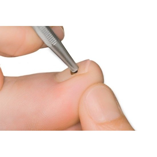 Onyclip kit de tratamiento de uñas encarnadas Onyclip-Spangen-Set-33041-Baehr-Podología