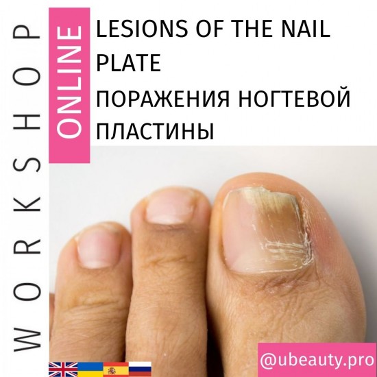 Przebieg Uszkodzenia płytki paznokcia: przyczyny, rodzaje, profilaktyka-2985-Workshop Ubeauty-Piękno i zdrowie. Wszystko dla salonów kosmetycznych